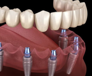 Implantes y Cirugía